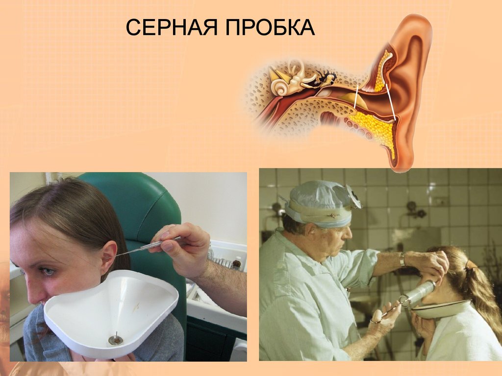Серная пробка. причины, симптомы и признаки, удаление :: polismed.com
